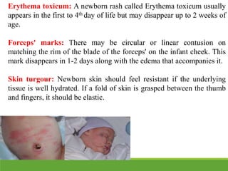 Erythema toxicum: A newborn rash called Erythema toxicum usually
appears in the first to 4th day of life but may disappear up to 2 weeks of
age.
Forceps' marks: There may be circular or linear contusion on
matching the rim of the blade of the forceps' on the infant cheek. This
mark disappears in 1-2 days along with the edema that accompanies it.
Skin turgour: Newborn skin should feel resistant if the underlying
tissue is well hydrated. If a fold of skin is grasped between the thumb
and fingers, it should be elastic.
 