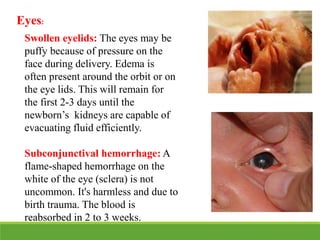 Eyes:
Swollen eyelids: The eyes may be
puffy because of pressure on the
face during delivery. Edema is
often present around the orbit or on
the eye lids. This will remain for
the first 2-3 days until the
newborn’s kidneys are capable of
evacuating fluid efficiently.
Subconjunctival hemorrhage: A
flame-shaped hemorrhage on the
white of the eye (sclera) is not
uncommon. It's harmless and due to
birth trauma. The blood is
reabsorbed in 2 to 3 weeks.
 