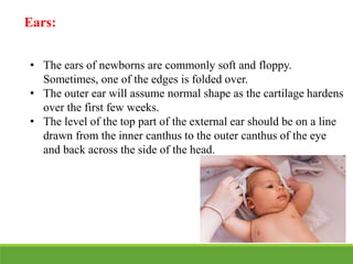 Ears:
• The ears of newborns are commonly soft and floppy.
Sometimes, one of the edges is folded over.
• The outer ear will assume normal shape as the cartilage hardens
over the first few weeks.
• The level of the top part of the external ear should be on a line
drawn from the inner canthus to the outer canthus of the eye
and back across the side of the head.
 
