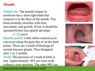 Mouth:
Tongue-tie: The normal tongue in
newborns has a short tight band that
connects it to the floor of the mouth. This
band normally stretches with time,
movement, and growth. If not, it should be
operated before true speech develops
( < 2 years).
Epstein pearls: Little white-colored cysts
can occur along the gum line or on the hard
palate. These are a result of blockage of
normal mucous glands. They disappear
after 1 to 2 months.
Teeth: The presence of a tooth at birth is
rare. Approximately 10% are extra teeth
without a root structure. The other 90% are
prematurely erupted normal teeth.
 