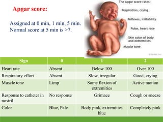 Apgar score:
Assigned at 0 min, 1 min, 5 min.
Normal score at 5 min is >7.
Sign 0 1 2
Heart rate Absent Below 100 Over 100
Respiratory effort Absent Slow, irregular Good, crying
Muscle tone Limp Some flexion of
extremities
Active motion
Response to catheter in
nostril
No response Grimace Cough or sneeze
Color Blue, Pale Body pink, extremities
blue
Completely pink
 