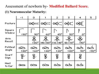 (1) Neuromuscular Maturity:
Assessment of newborn by- Modified Ballard Score.
 