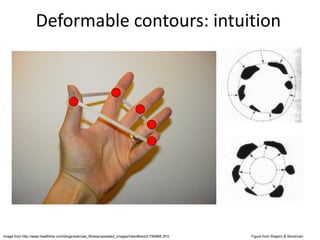 Deformable contours: intuition
Image from http://www.healthline.com/blogs/exercise_fitness/uploaded_images/HandBand2-795868.JPG Figure from Shapiro & Stockman
 