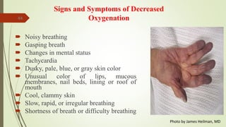 44
Signs and Symptoms of Decreased
Oxygenation
 Noisy breathing
 Gasping breath
 Changes in mental status
 Tachycardia
 Dusky, pale, blue, or gray skin color
 Unusual color of lips, mucous
membranes, nail beds, lining or roof of
mouth
 Cool, clammy skin
 Slow, rapid, or irregular breathing
 Shortness of breath or difficulty breathing
Photo by James Heilman, MD
 