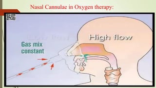Nasal Cannulae in Oxygen therapy:
 
