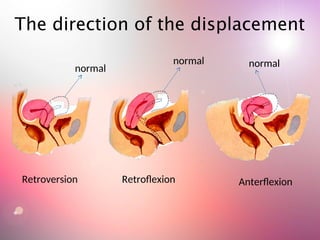 The direction of the displacement
normal
normal normal
Retroflexion
Retroversion Anterflexion
 