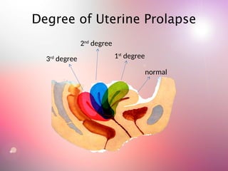 Degree of Uterine Prolapse
3rd
degree
2nd
degree
1st
degree
normal
 