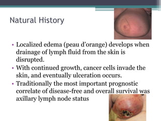 Natural History
• Localized edema (peau d’orange) develops when
drainage of lymph fluid from the skin is
disrupted.
• With continued growth, cancer cells invade the
skin, and eventually ulceration occurs.
• Traditionally the most important prognostic
correlate of disease-free and overall survival was
axillary lymph node status
 