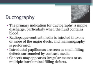 Ductography
• The primary indication for ductography is nipple
discharge, particularly when the fluid contains
blood.
• Radiopaque contrast media is injected into one
or more of the major ducts, and mammography
is performed.
• Intraductal papillomas are seen as small filling
defects surrounded by contrast media
• Cancers may appear as irregular masses or as
multiple intraluminal filling defects.
 