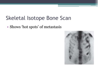 Skeletal Isotope Bone Scan
• Shows ‘hot spots’ of metastasis
 