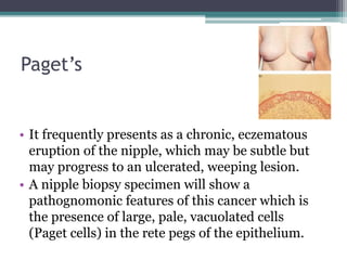 Paget’s
• It frequently presents as a chronic, eczematous
eruption of the nipple, which may be subtle but
may progress to an ulcerated, weeping lesion.
• A nipple biopsy specimen will show a
pathognomonic features of this cancer which is
the presence of large, pale, vacuolated cells
(Paget cells) in the rete pegs of the epithelium.
 