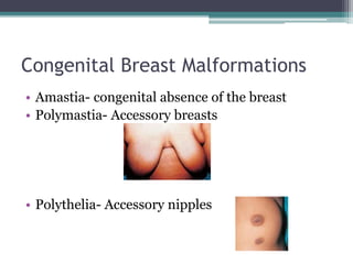 Congenital Breast Malformations
• Amastia- congenital absence of the breast
• Polymastia- Accessory breasts
• Polythelia- Accessory nipples
 