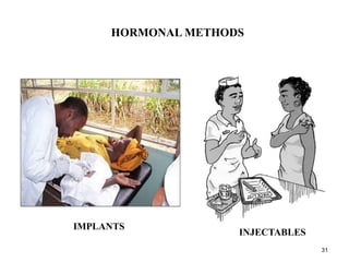 HORMONAL METHODS
IMPLANTS
INJECTABLES
31
 