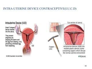 INTRA-UTERINE DEVICE CONTRACEPTIVE(I.U.C.D)
33
 