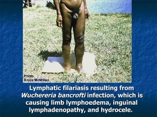 Lymphatic filariasis resulting from Wuchereria bancrofti infection, which is causing limb lymphoedema, inguinal lymphadenopathy, and hydrocele.