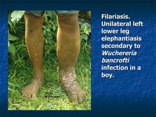 Filariasis. Unilateral left lower leg elephantiasis secondary to Wuchereria bancrofti infection in a boy.