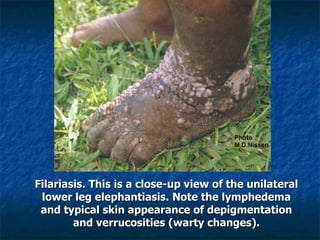 Filariasis. This is a close-up view of the unilateral lower leg elephantiasis. Note the lymphedema and typical skin appearance of depigmentation and verrucosities (warty changes).