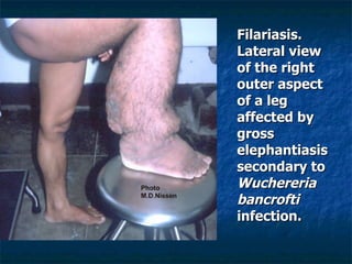 Filariasis. Lateral view of the right outer aspect of a leg affected by gross elephantiasis secondary to Wuchereria bancrofti infection.