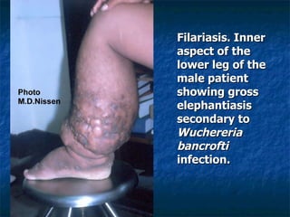 Filariasis. Inner aspect of the lower leg of the male patient showing gross elephantiasis secondary to Wuchereria bancrofti infection.
