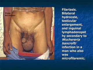 Filariasis. Bilateral hydrocele, testicular enlargement, and inguinal lymphadenopathy secondary to Wuchereria bancrofti infection in a man who also was microfilaremic.