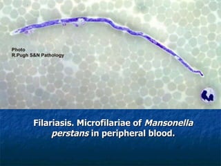 Filariasis. Microfilariae of Mansonella perstans in peripheral blood.