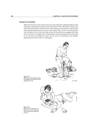 396 CHAPTER 10 • SAFE USE OF PESTICIDES
Fig. 10.17
Remove contaminated clothing
immediately and wash the skin
(adapted from 3).
Fig. 10.18
Place an unconscious pa-
tient on her or his side and
tilt the head back (adapted
from 5).
Caring for the patient
Make the patient lie down and rest because poisoning with organophosphorus and
carbamate compounds is made worse by movement. Place the patient on her or his
side with the head lower than the body. If the patient is unconscious, pull the chin
forward and the head back to ensure a clear airway (Fig. 10.18). Cover the patient
with a blanket if he or she feels cold, and cool the patient by sponging with cold
water if excessive sweating occurs. If the patient vomits spontaneously, ensure that
he or she does not inhale the vomit. In the event of convulsions, put padded
material between the teeth to avoid injury.
 