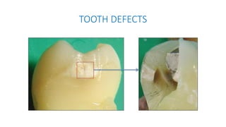 Tooth Defects Animation LECTURE-YR-2-INTRO-OPERATIVE DENT-21.pptx