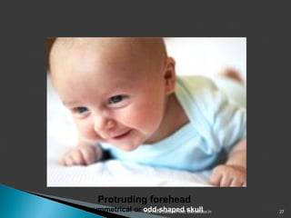 Lecture rickets | PPT