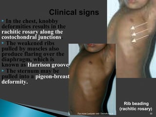 Lecture rickets | PPT