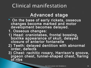 Lecture rickets | PPT