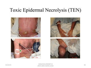 Toxic Epidermal Necrolysis (TEN)
01/23/15 94
GKM/KISIIU/MBSM713
/BIOC.AMIC.AGENS.LEC02
 