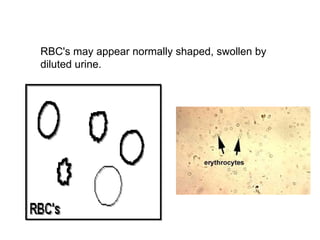 RBC's may appear normally shaped, swollen by
diluted urine.
 