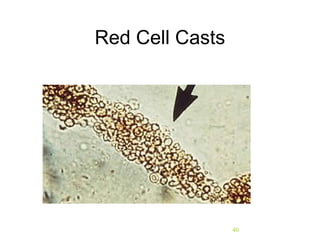 40
Red Cell Casts
 