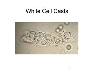 41
White Cell Casts
 