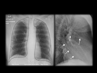 Sternum Rx Radiological anatomy of the Chest. .pptx