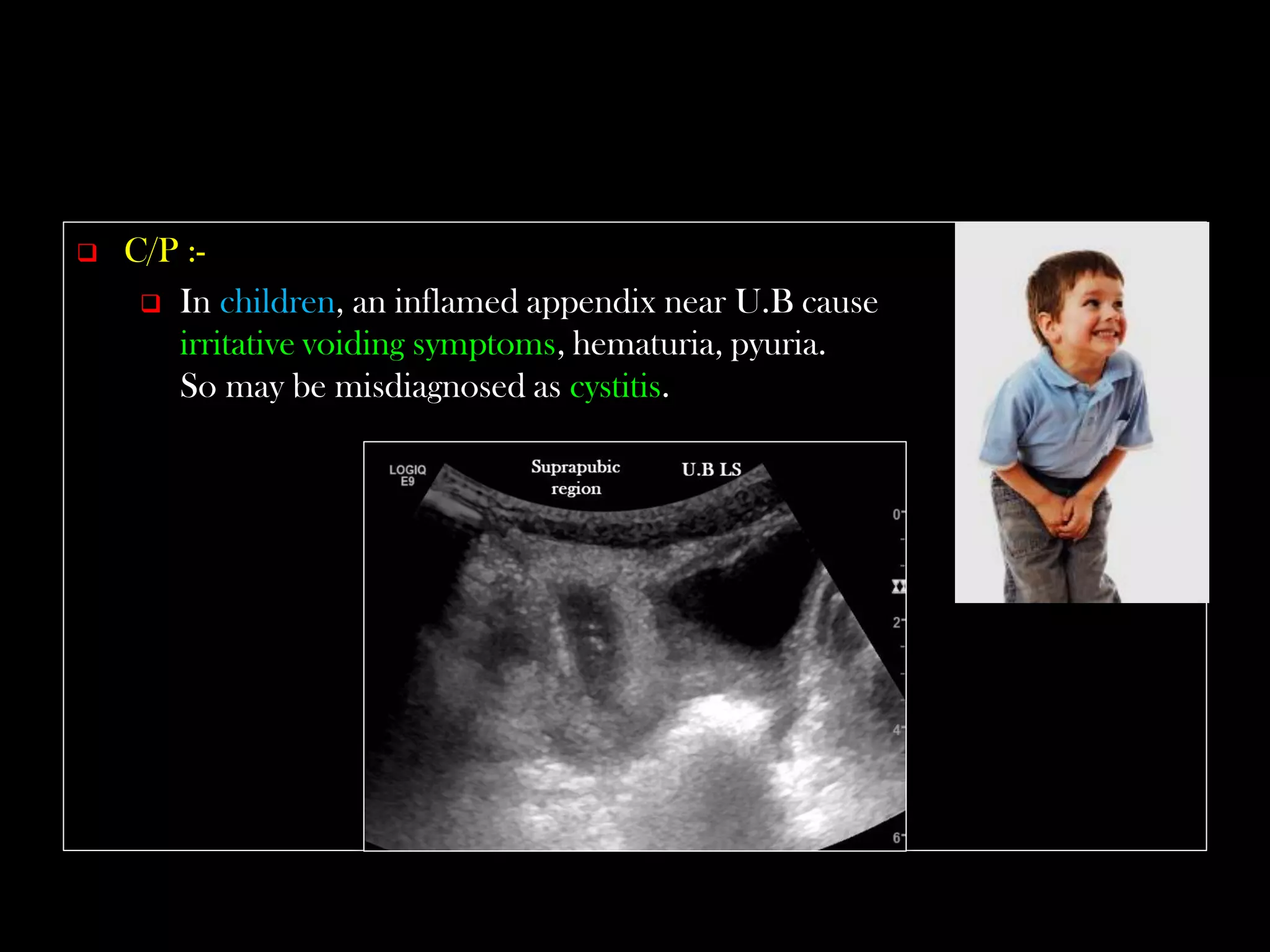 Emergency Ultrasound Course -Lecture 04 -Acute Appendicitis -Part 1 | PDF