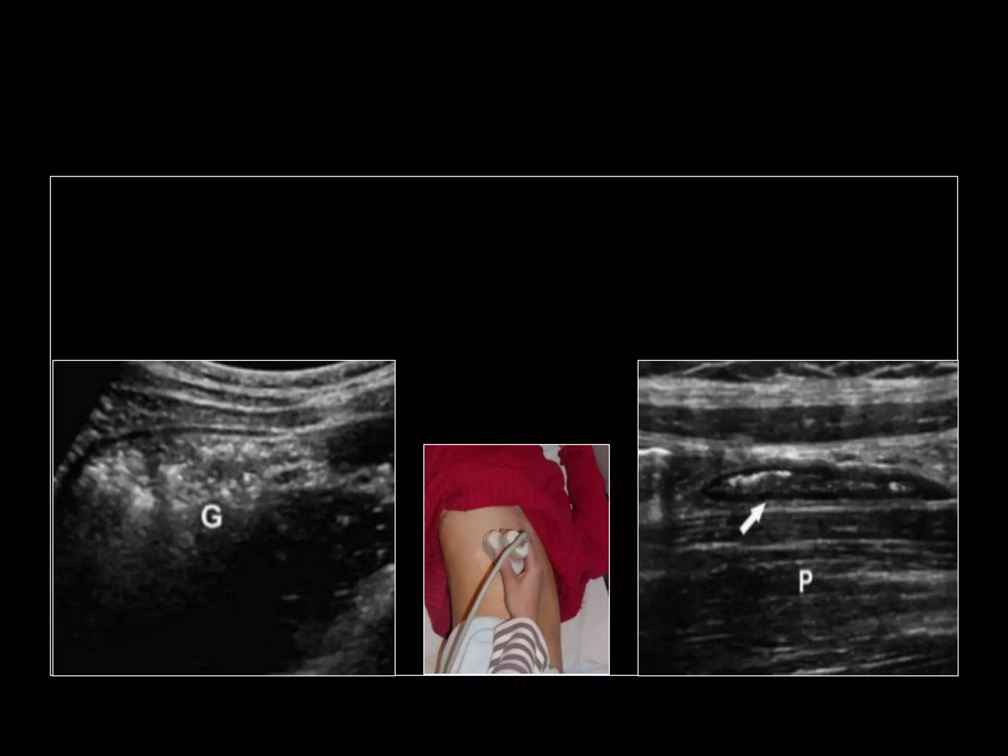 Emergency Ultrasound Course -Lecture 04 -Acute Appendicitis -Part 1 | PDF