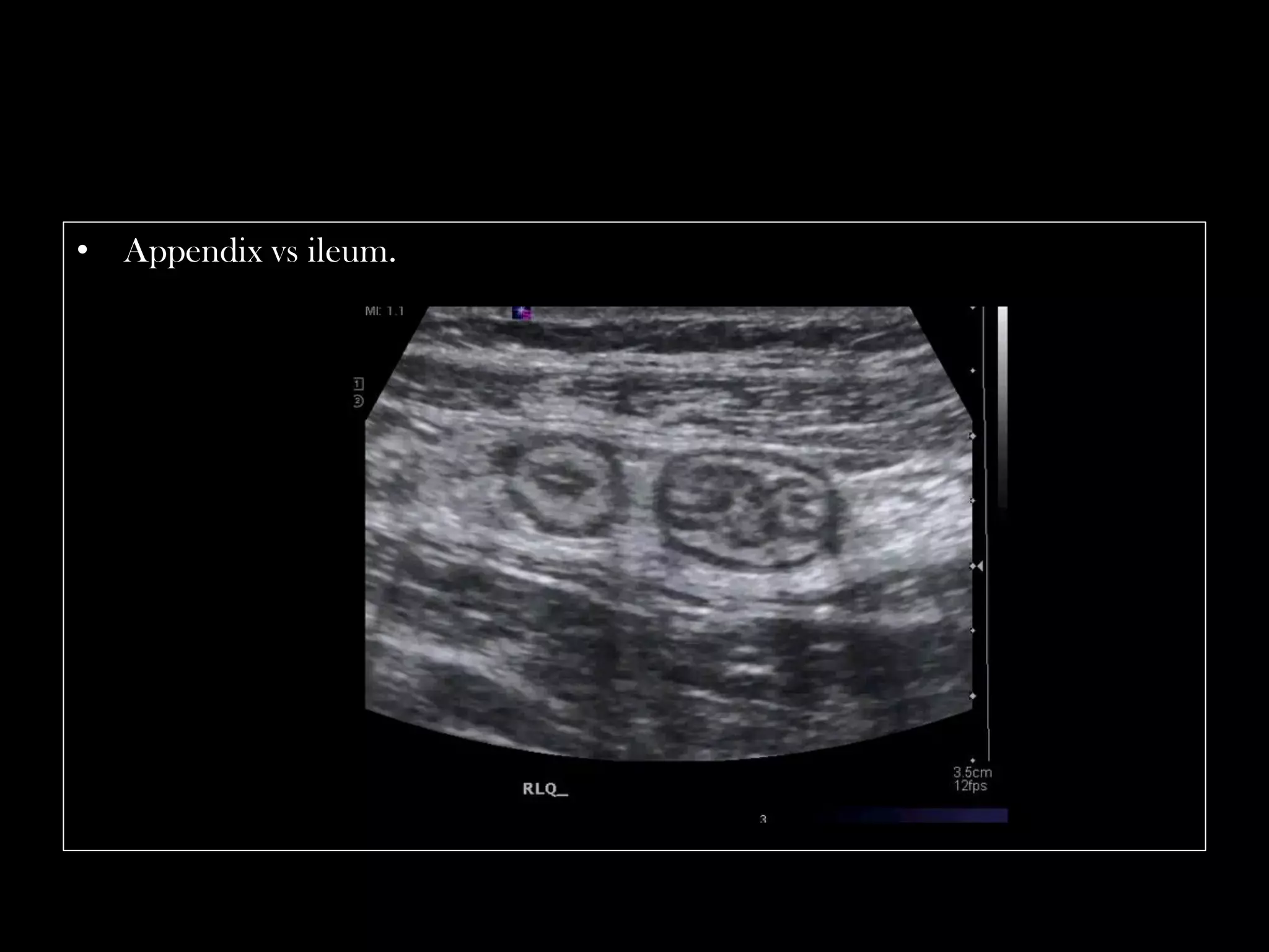 Emergency Ultrasound Course -Lecture 04 -Acute Appendicitis -Part 1 ...