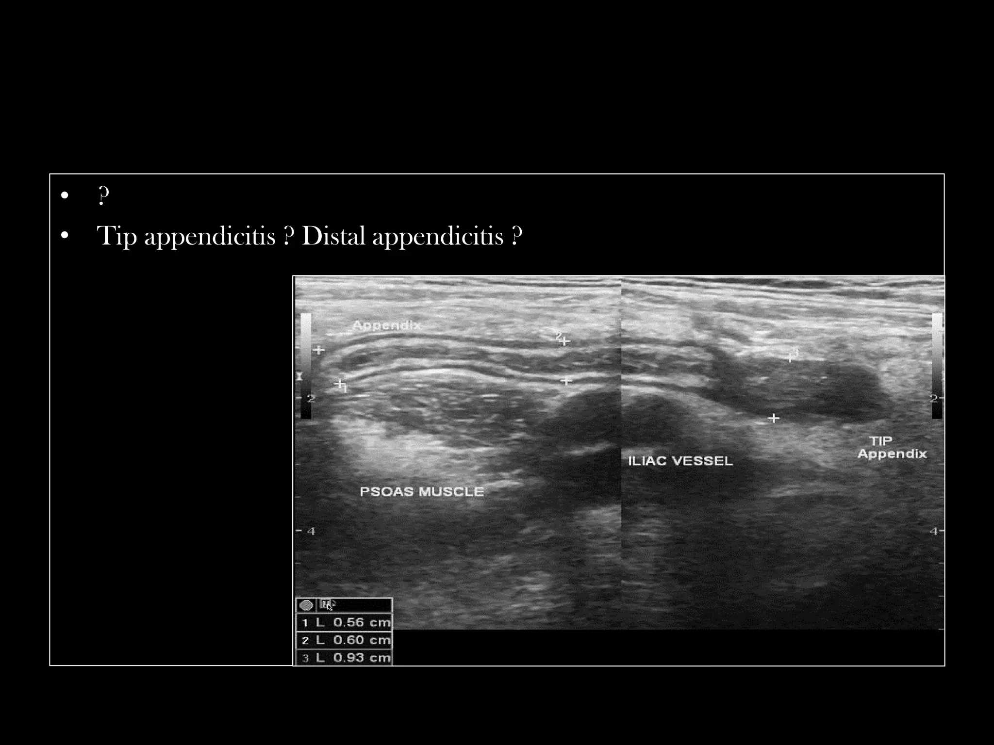 Emergency Ultrasound Course -Lecture 04 -Acute Appendicitis -Part 1 ...