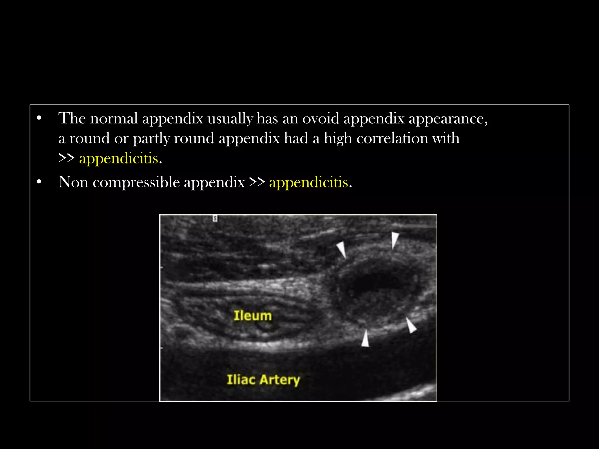 Emergency Ultrasound Course -Lecture 04 -Acute Appendicitis -Part 1 ...