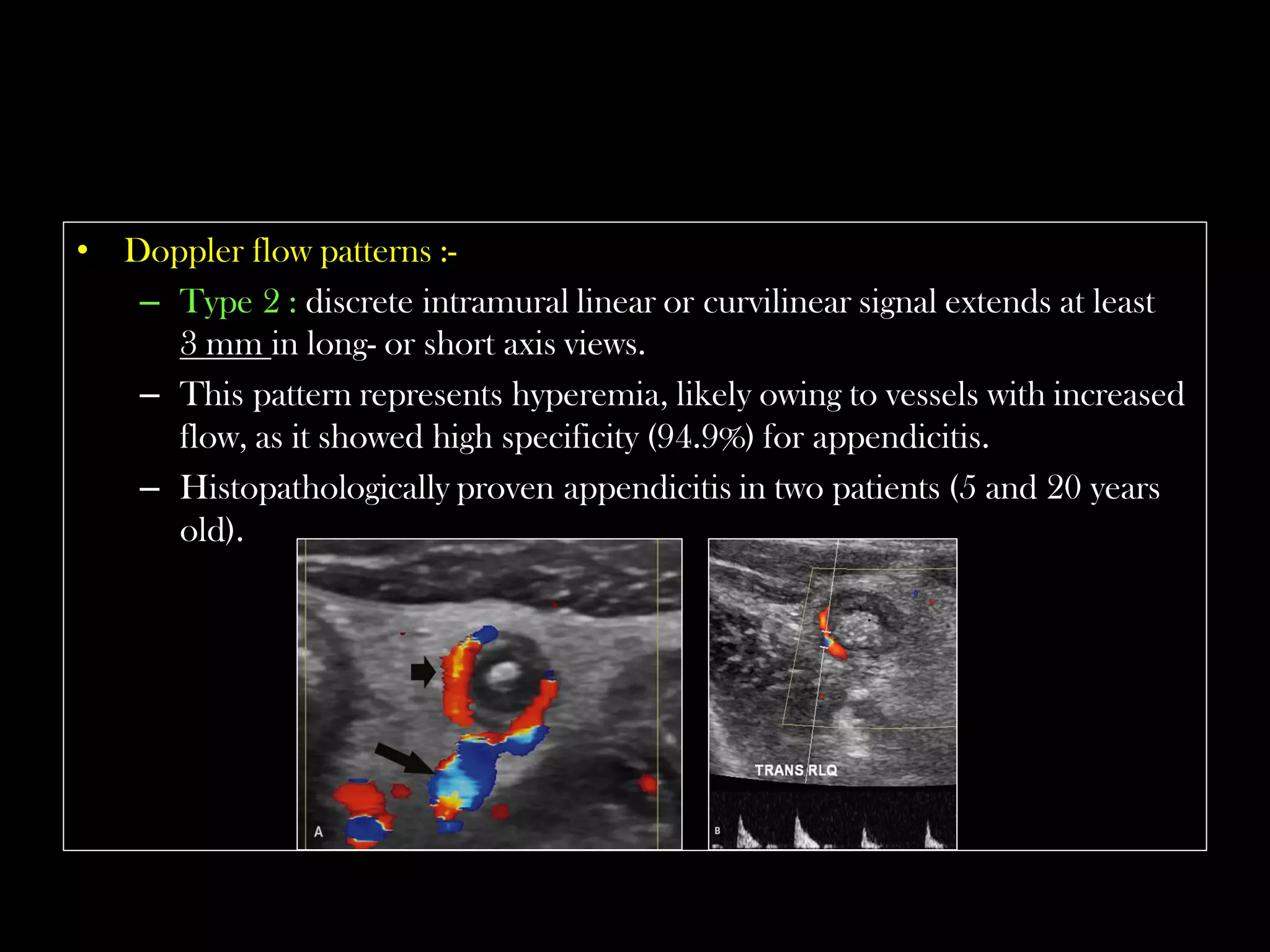 Emergency Ultrasound Course -Lecture 04 -Acute Appendicitis -Part 1 | PDF
