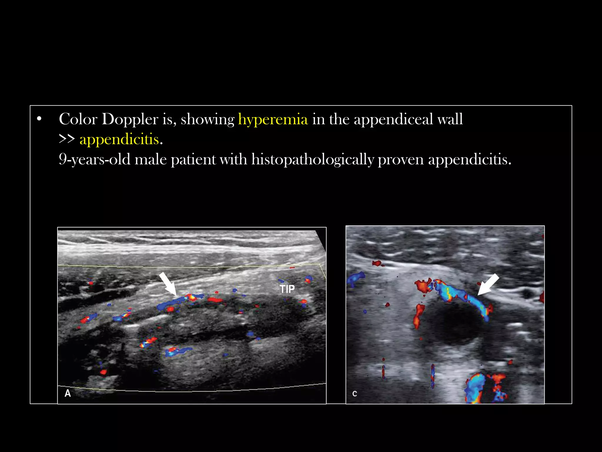 Emergency Ultrasound Course -Lecture 04 -Acute Appendicitis -Part 1 | PDF