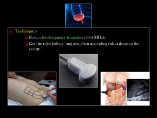 Appendix Transducer Emergency Ultrasound Course -Lecture 04 -Acute Appendicitis -Part 1 | PDF