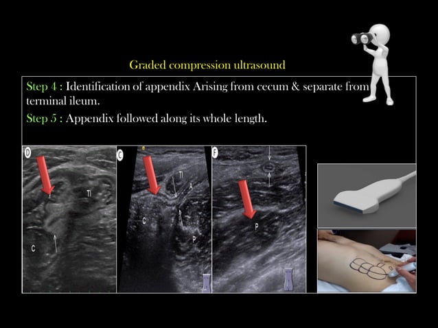 Emergency Ultrasound Course -Lecture 04 -Acute Appendicitis -Part 1 ...
