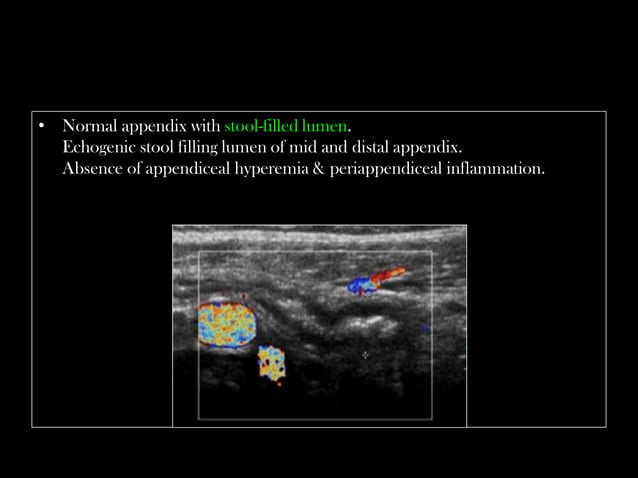 Emergency Ultrasound Course -Lecture 04 -Acute Appendicitis -Part 1 ...