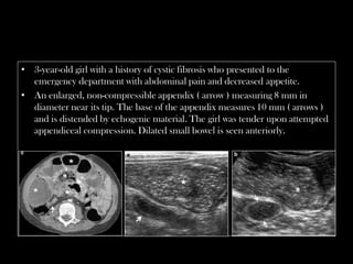 Emergency Ultrasound Course -Lecture 04 -Acute Appendicitis -Part 1 | PDF
