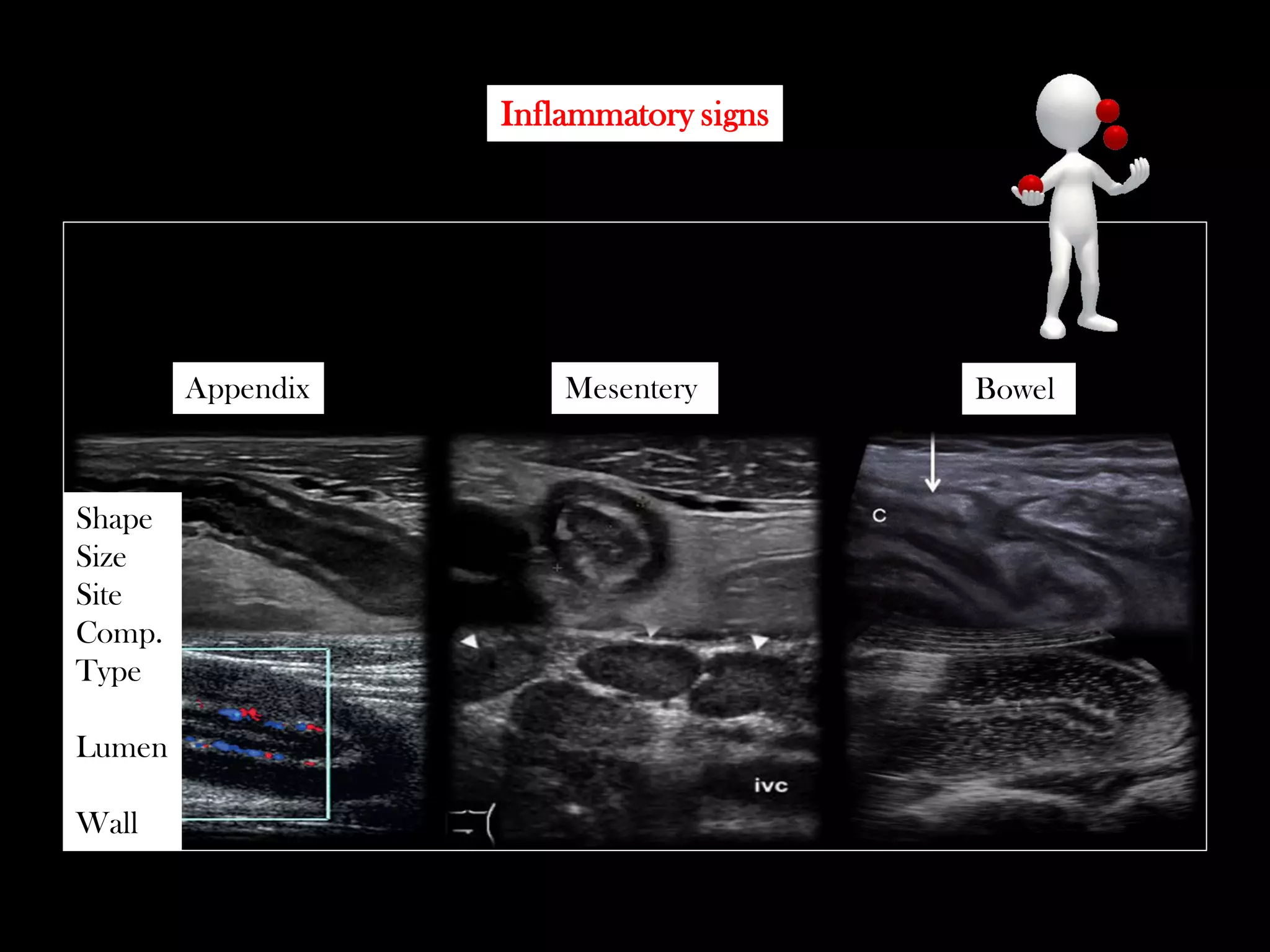 Emergency Ultrasound Course -Lecture 04 -Acute Appendicitis -Part 2 | PDF