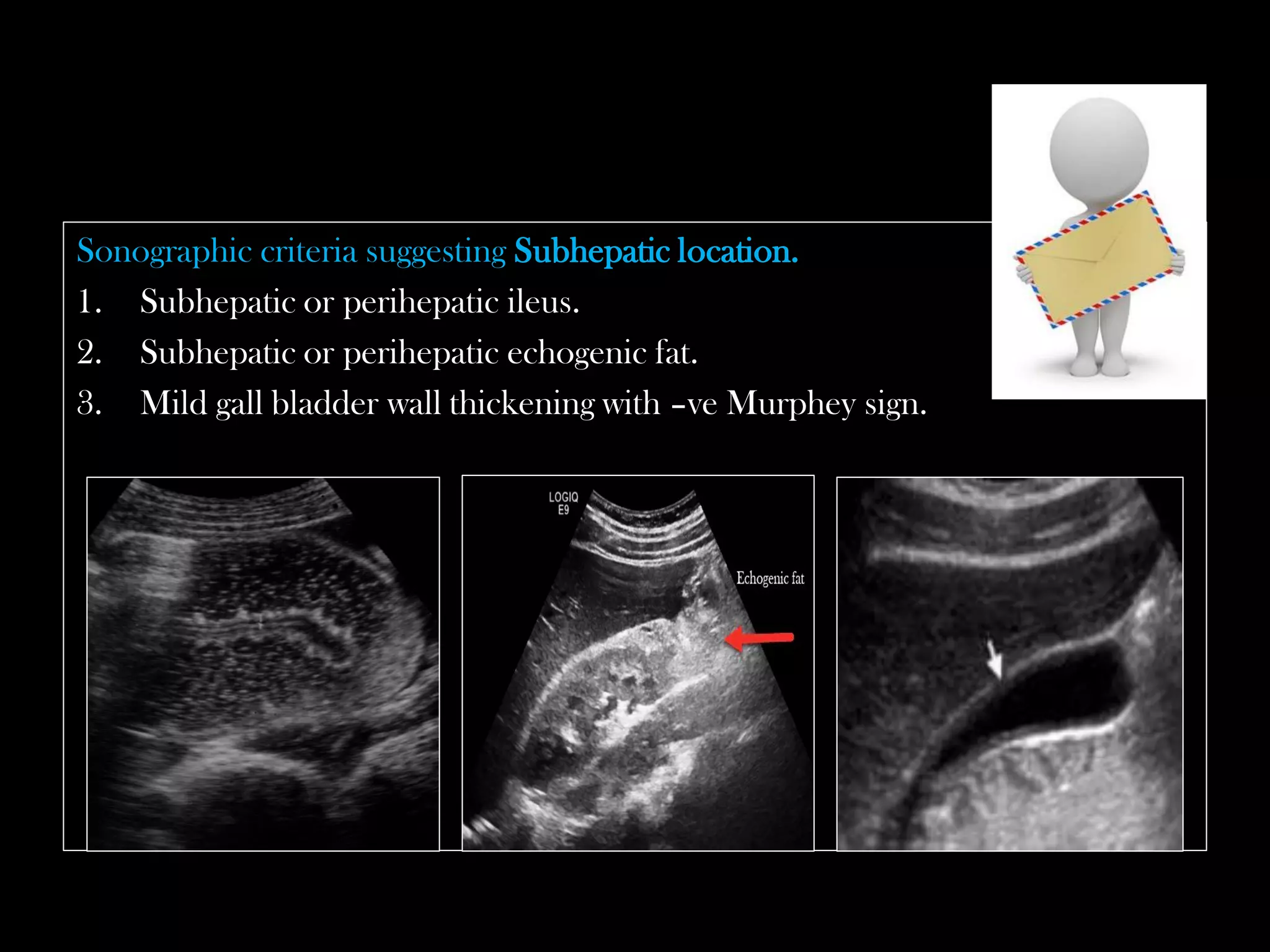 Appendix Murphy Sign Emergency Ultrasound Course -Lecture 04 -Acute Appendicitis -Part 2 | PDF