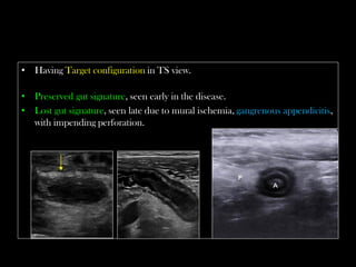 Target. Sign Appencitis Emergency Ultrasound Course -Lecture 04 -Acute Appendicitis -Part 2 | PDF