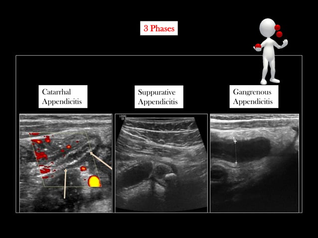 Emergency Ultrasound Course -Lecture 04 -Acute Appendicitis -Part 2 ...